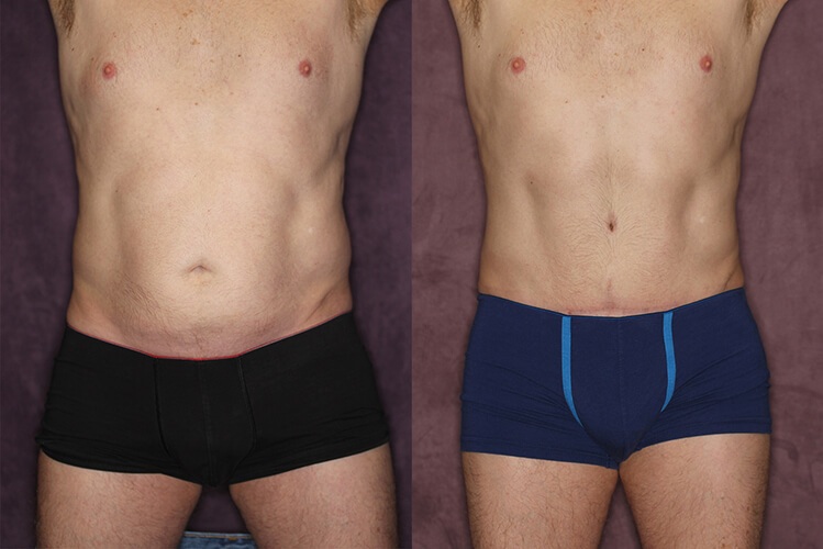 male tummy tuck male tummy tuck