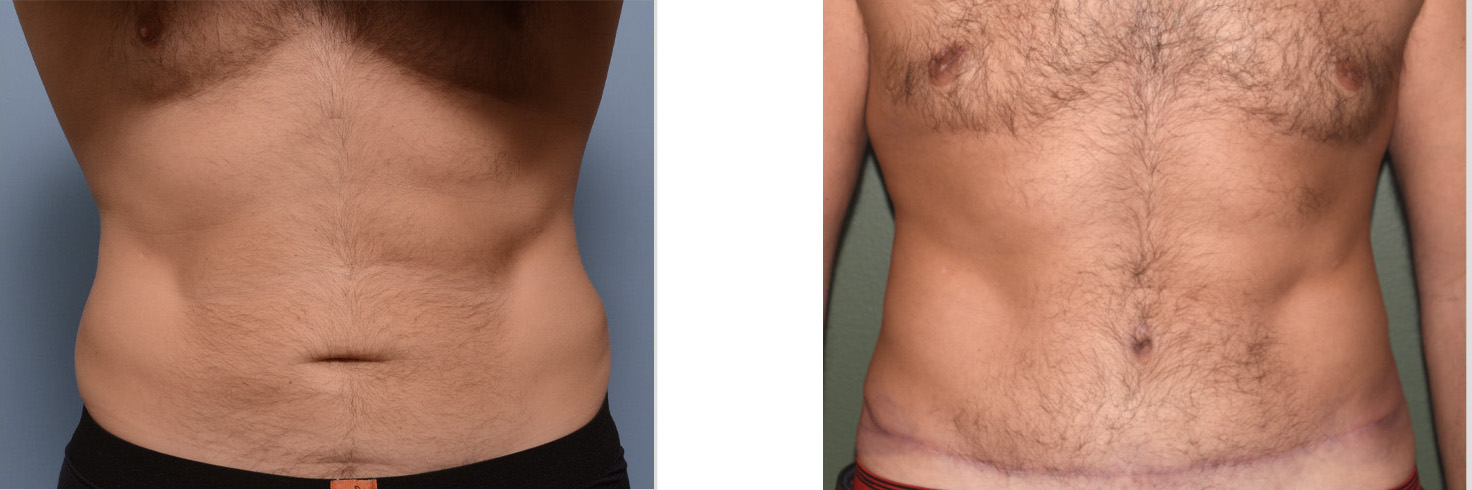 male tummy tuck male tummy tuck