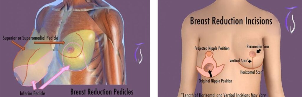 mammoplasty reduction