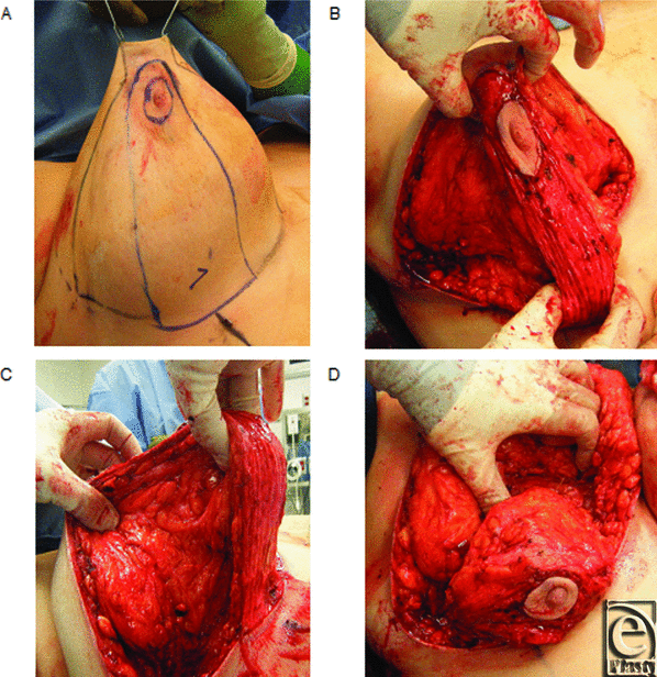 mammoplasty reduction