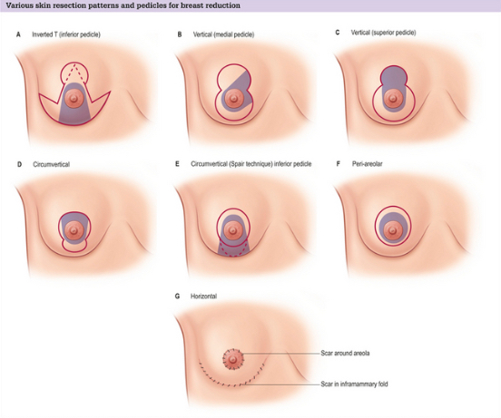 Mammoplasty reduction: Reducing size for comfort and proportion