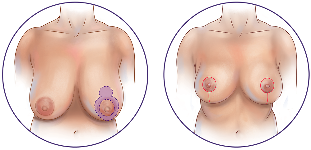 mammoplasty reduction