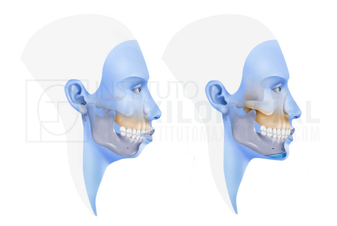 mentoplasty
