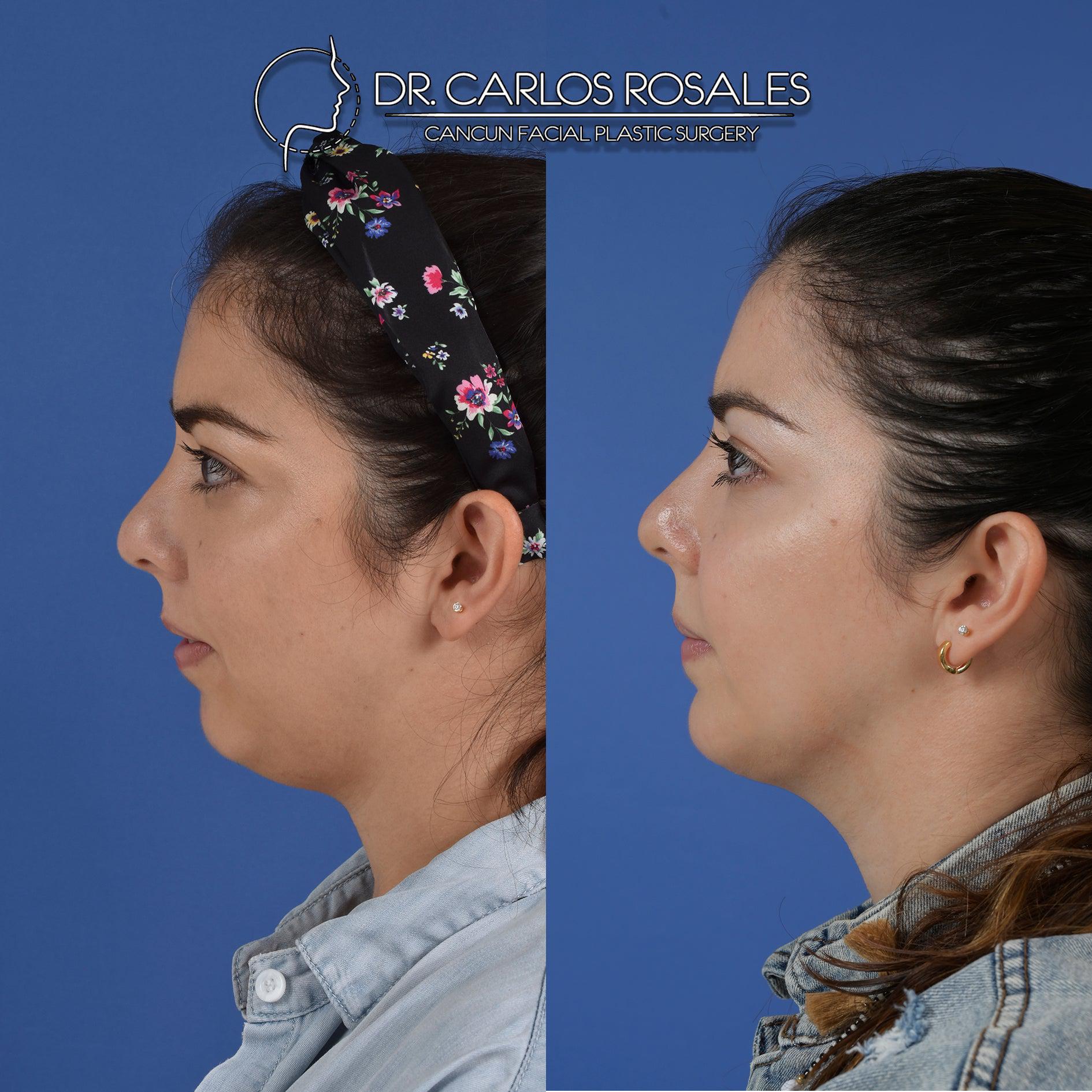 mentoplasty