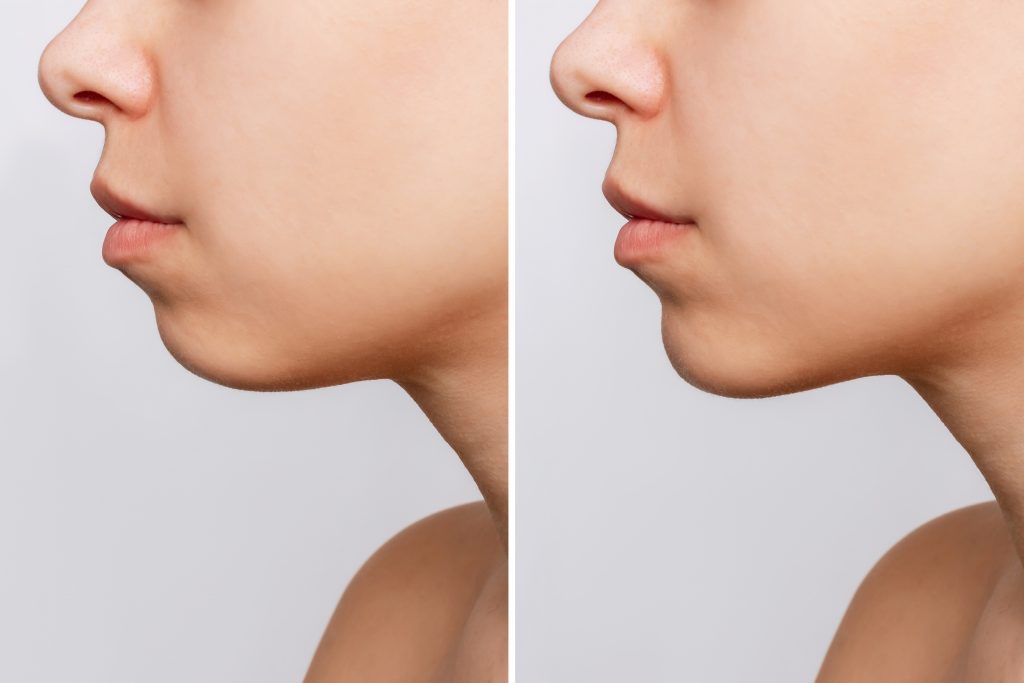 mentoplasty