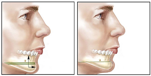 Mentoplasty: Reshaping and enhancing the chin