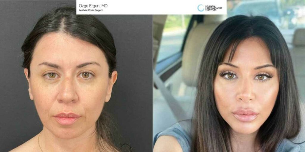 mid face lift mid face lift