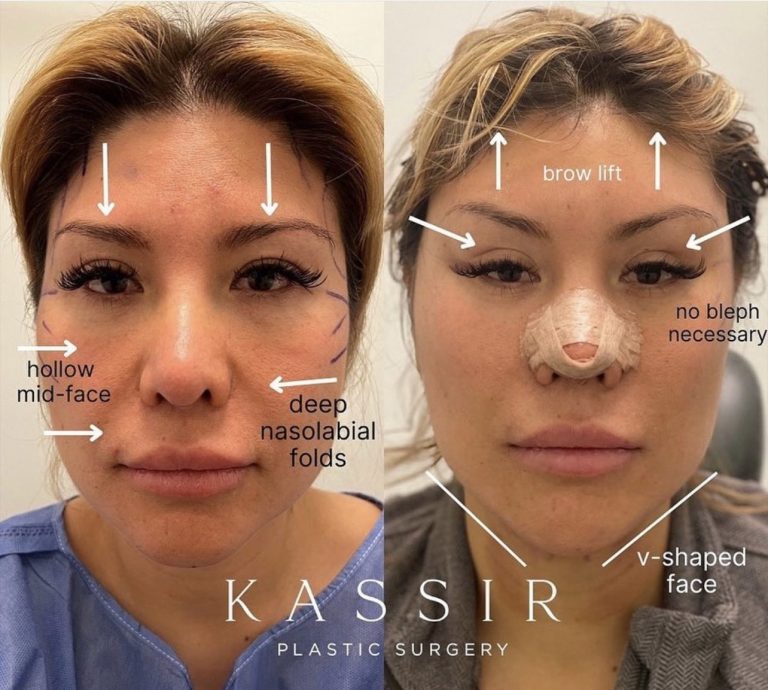 Mid face lift: Restoring youthfulness to the central face