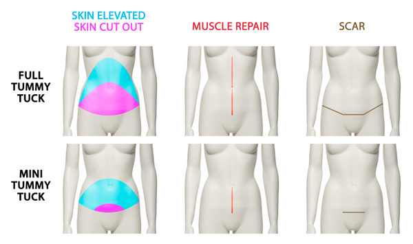 mini abdominoplasty mini abdominoplasty