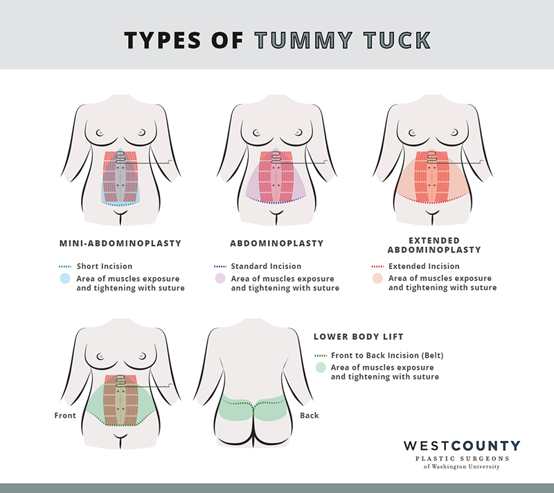 mini abdominoplasty mini abdominoplasty
