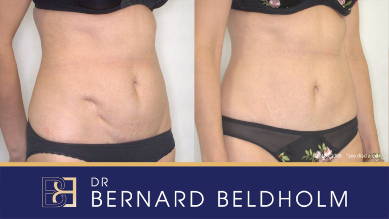 Mini Abdominoplasty: A less invasive tummy tuck option