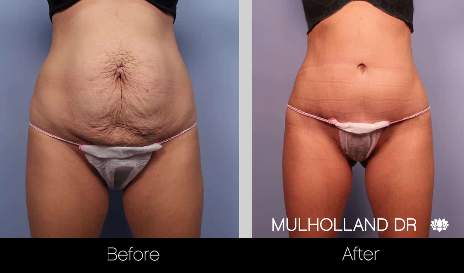 mini abdominoplasty mini abdominoplasty