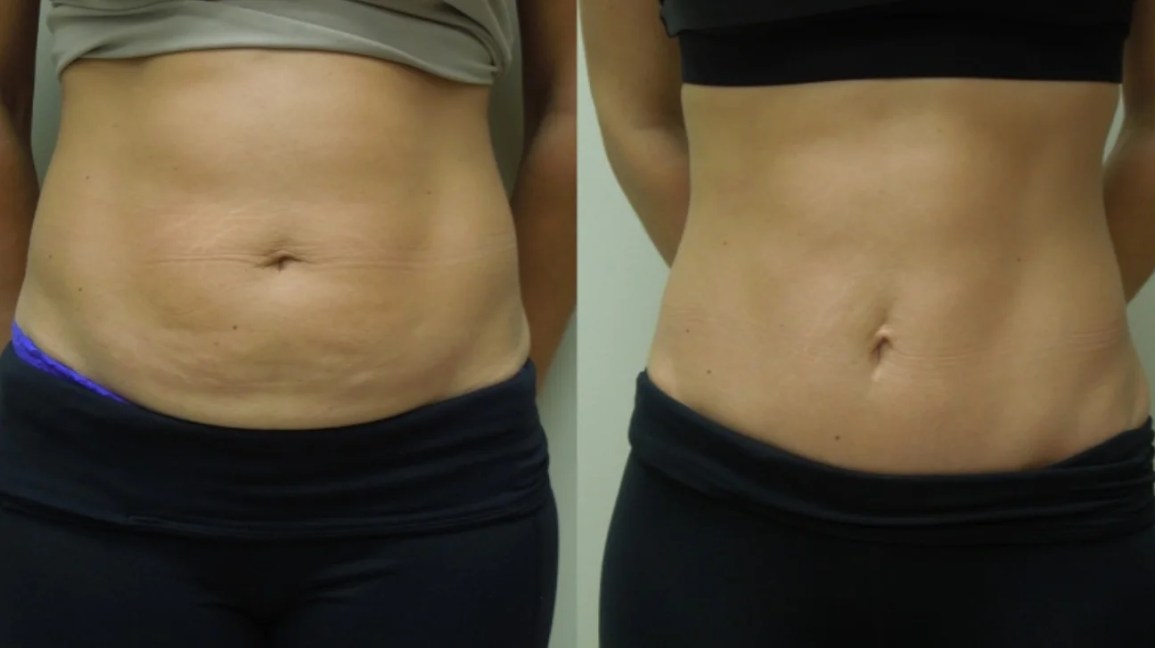 mini abdominoplasty mini abdominoplasty