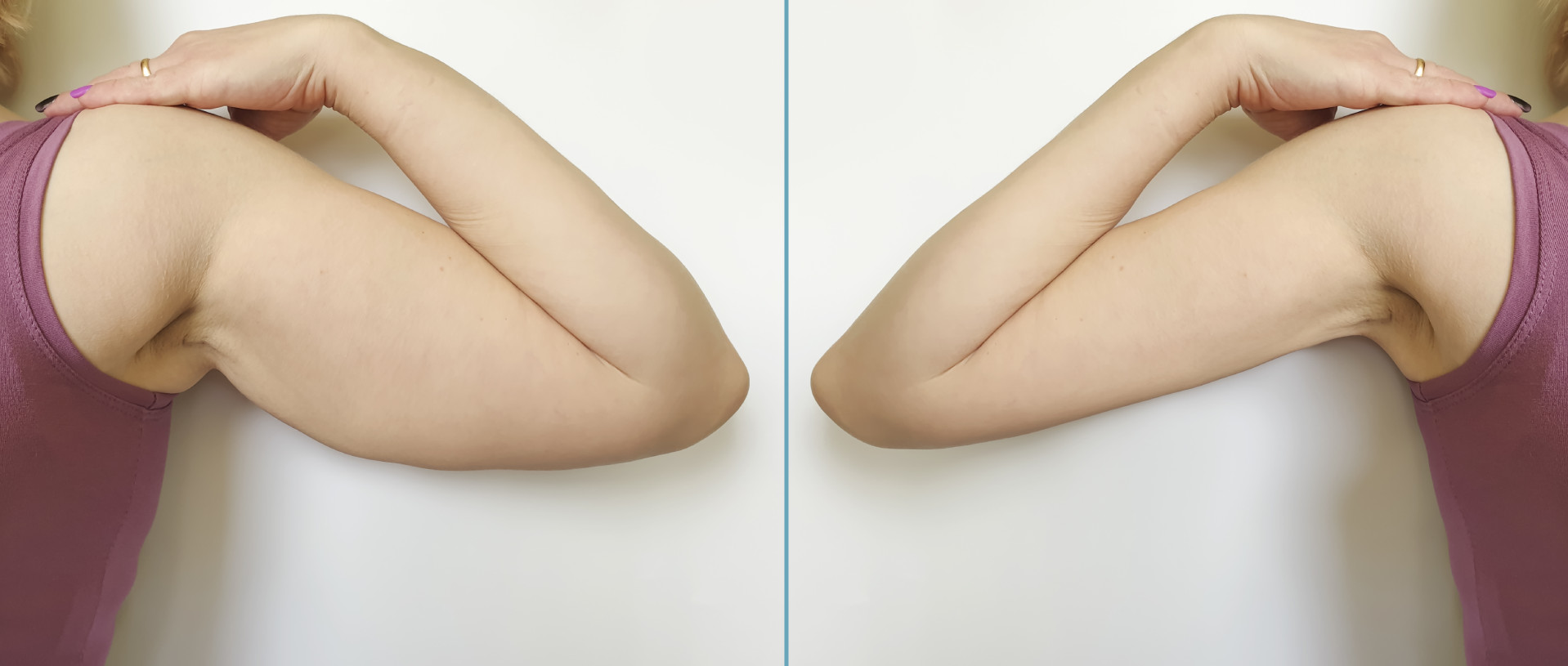 mini arm lift mini arm lift