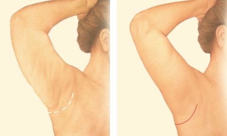 mini arm lift mini arm lift