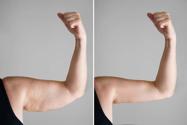 Mini Arm Lift: Toning and refining the upper arms