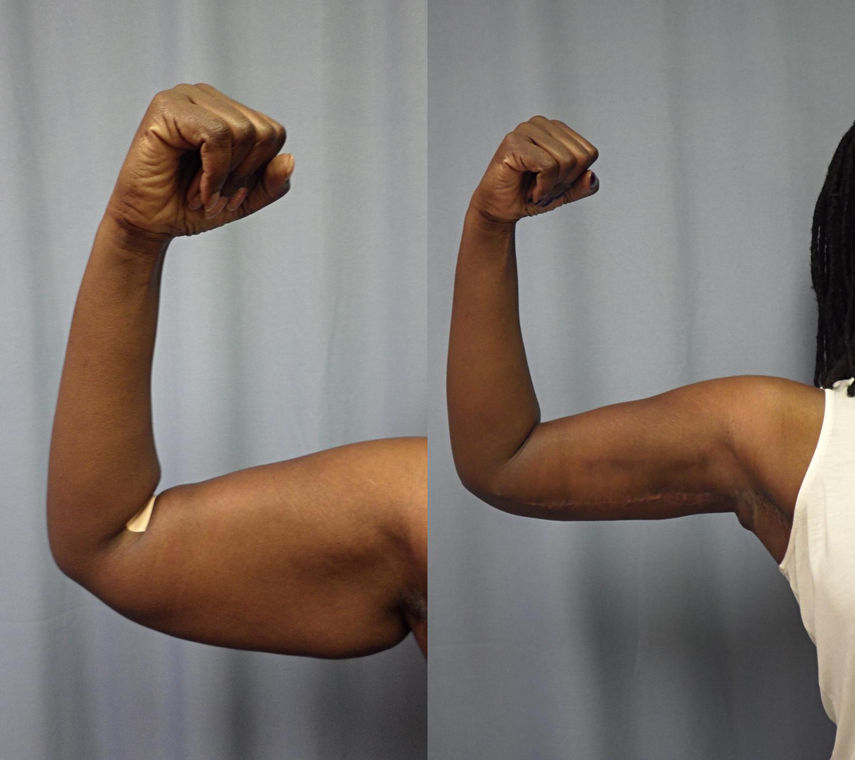 mini arm lift mini arm lift