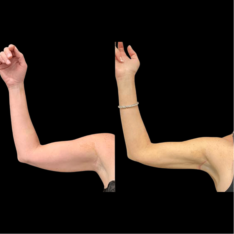 mini arm lift mini arm lift