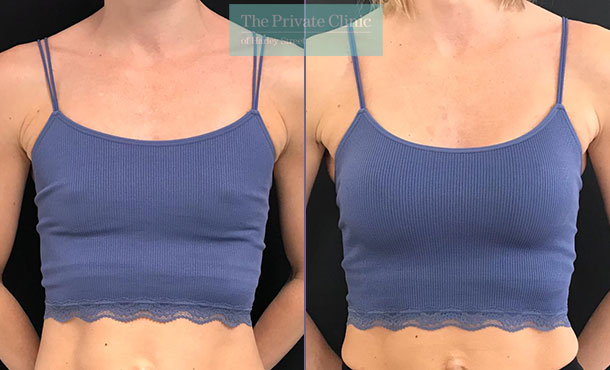 Mini boob job: Subtle augmentations for a natural look