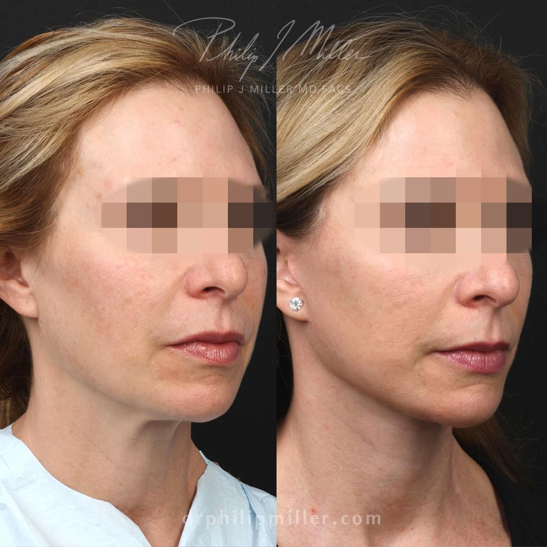 mini neck lift