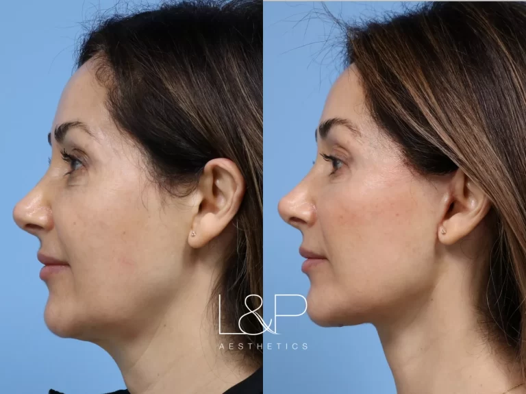 Mini neck lift: A subtle solution for a smoother neckline