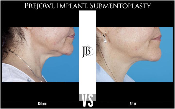 mini neck lift