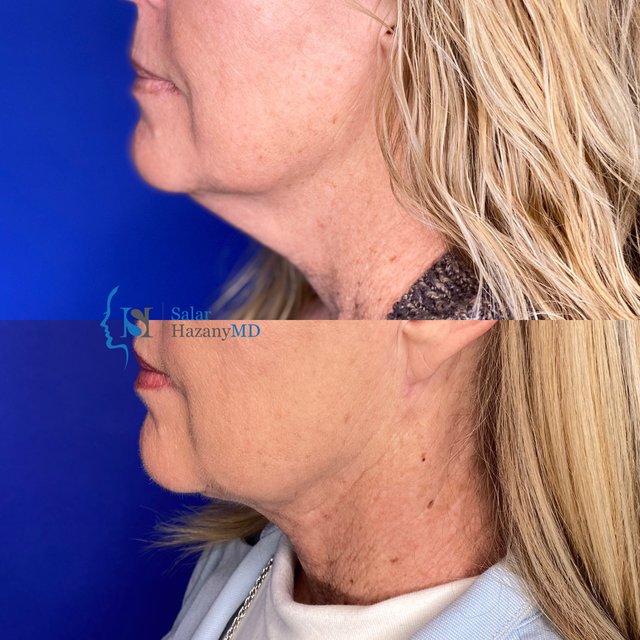 mini neck lift
