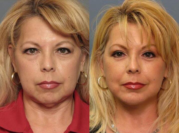 mini neck lift cost mini neck lift cost