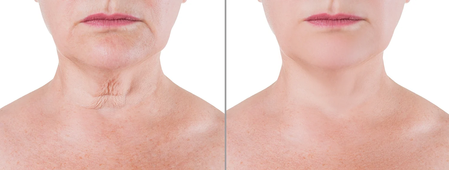 mini neck lift cost mini neck lift cost