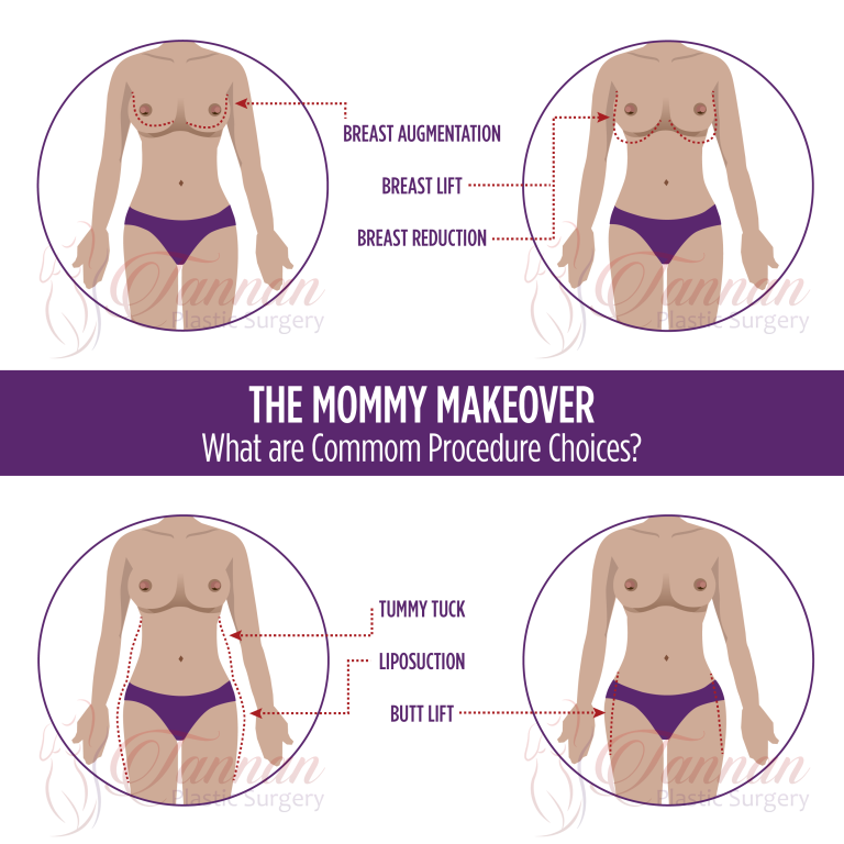 Mommy makeover: A complete transformation for mothers