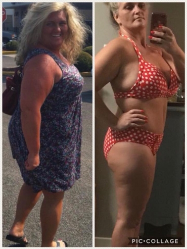 mommy makeover price mommy makeover price