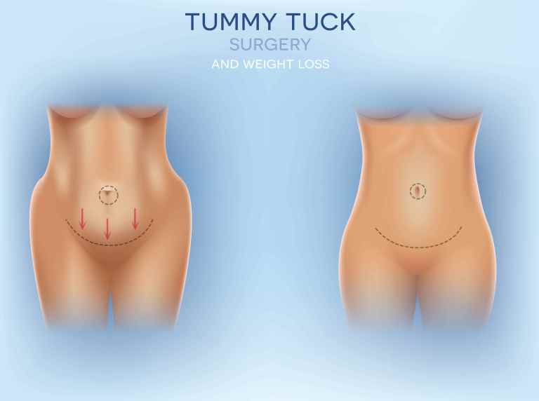 Mommy Tuck: Restoring confidence post-pregnancy