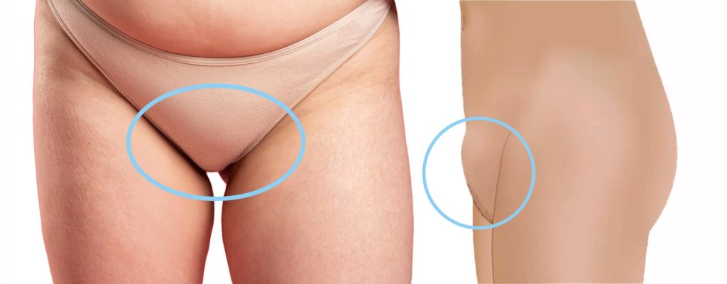 mons pubis reduction mons pubis reduction