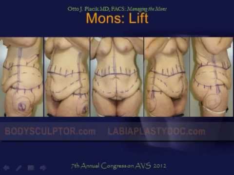 mons pubis reduction mons pubis reduction