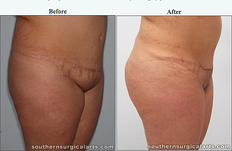 Mons Pubis Reduction: Refining intimate areas