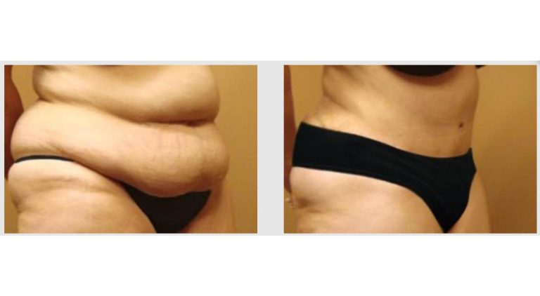 Monsplasty cost: Pricing details for pubic area contouring
