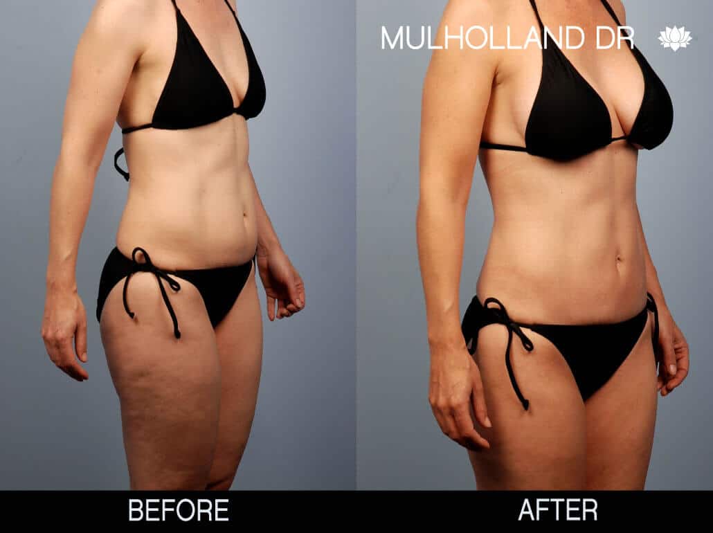 mummy makeover cost mummy makeover cost