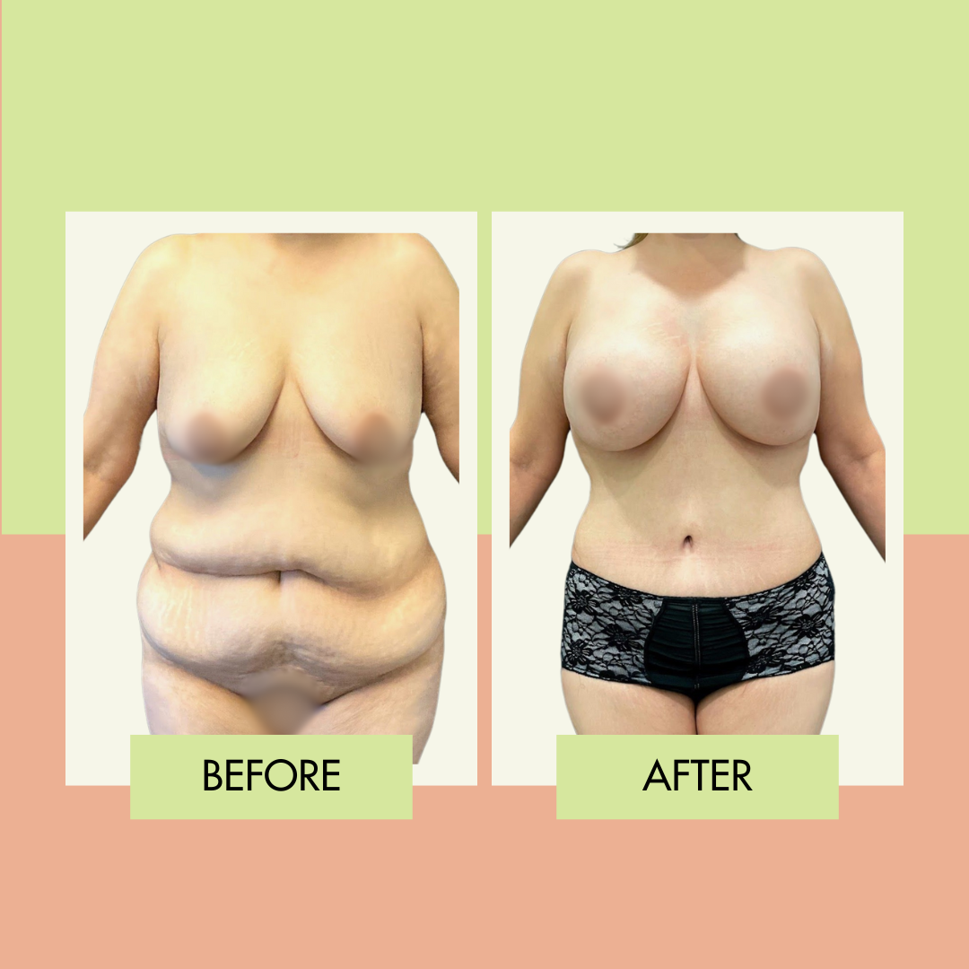 mummy makeover cost mummy makeover cost