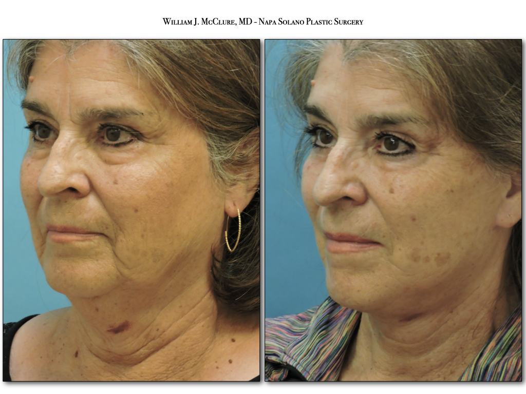 napa solano plastic surgery napa solano plastic surgery