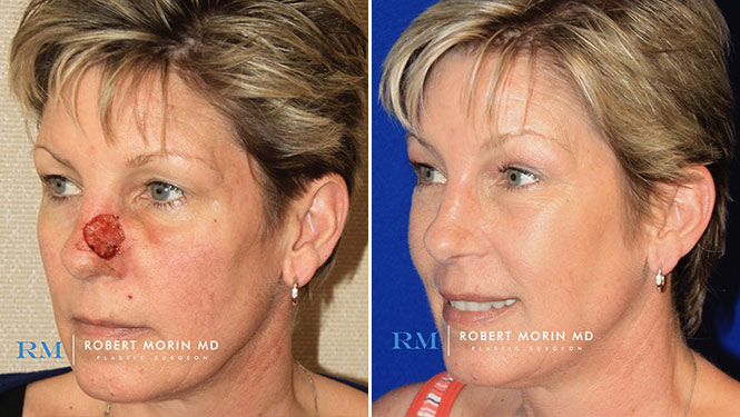 nasal reconstruction surgery nasal reconstruction surgery
