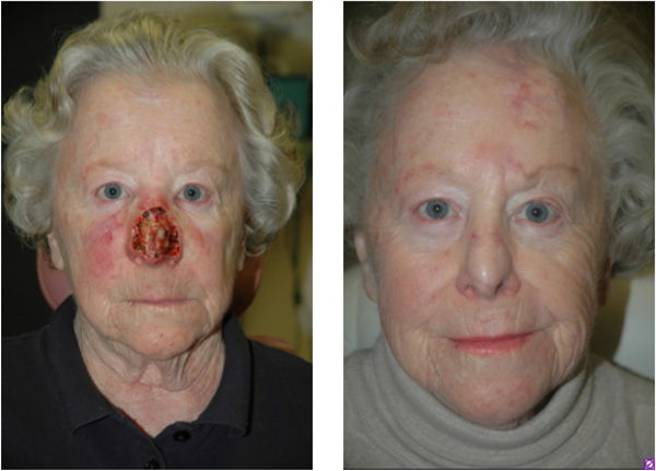 Nasal Reconstruction Surgery: Restoring structure and function