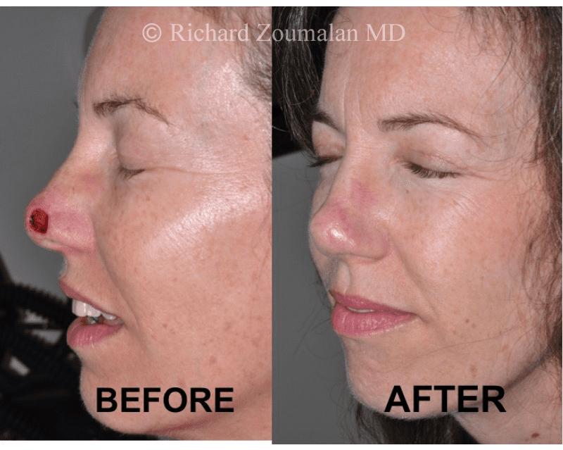 nasal reconstruction surgery nasal reconstruction surgery