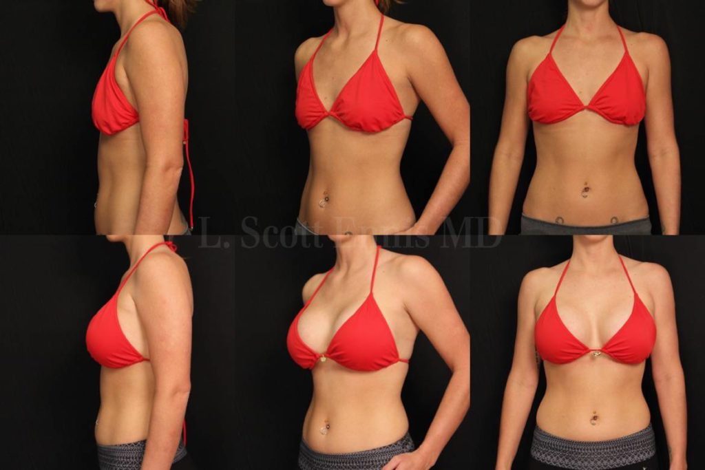 natural breast enhancement