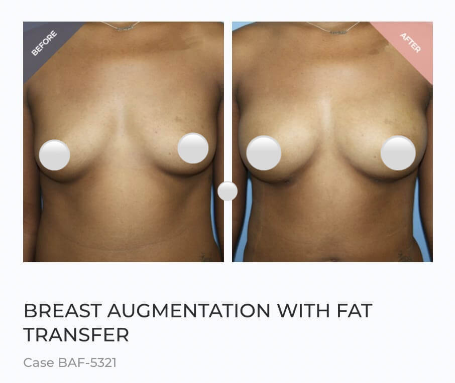 natural breast enhancement