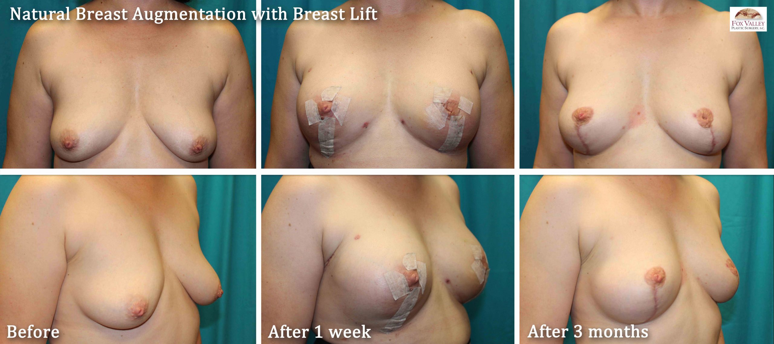 natural breast