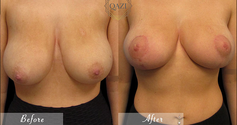 natural breast