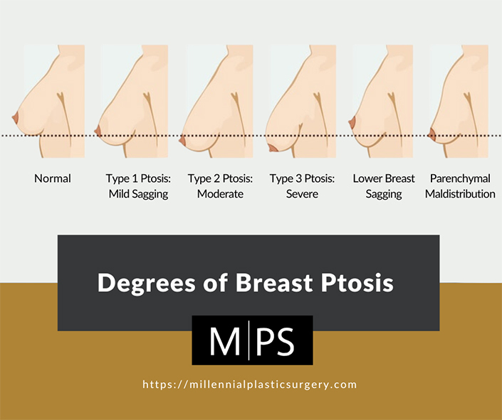 natural breast