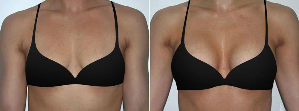 natural breast enlargement