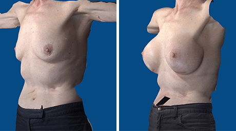 natural breast implants natural breast implants