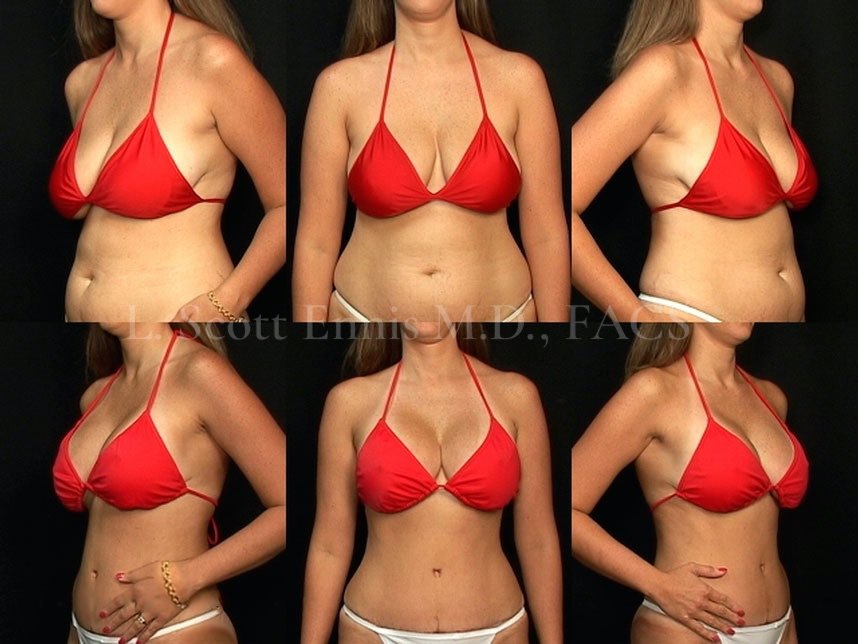 natural breast implants natural breast implants